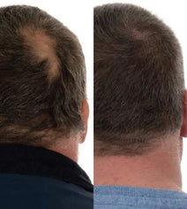 Foligain haargroei behandeling (man)