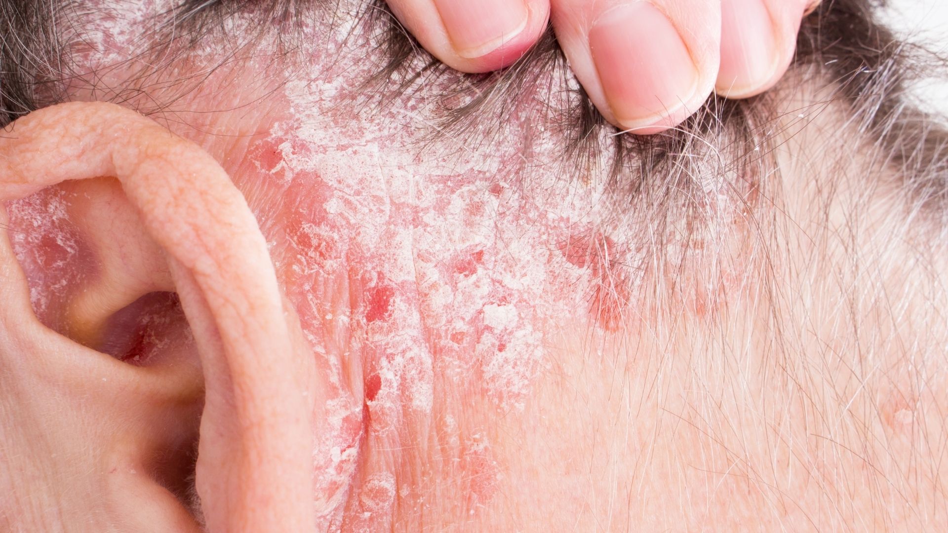 Tinea Capitis, or Yeast? Anybody have personal experience with this? :  r/dandruff