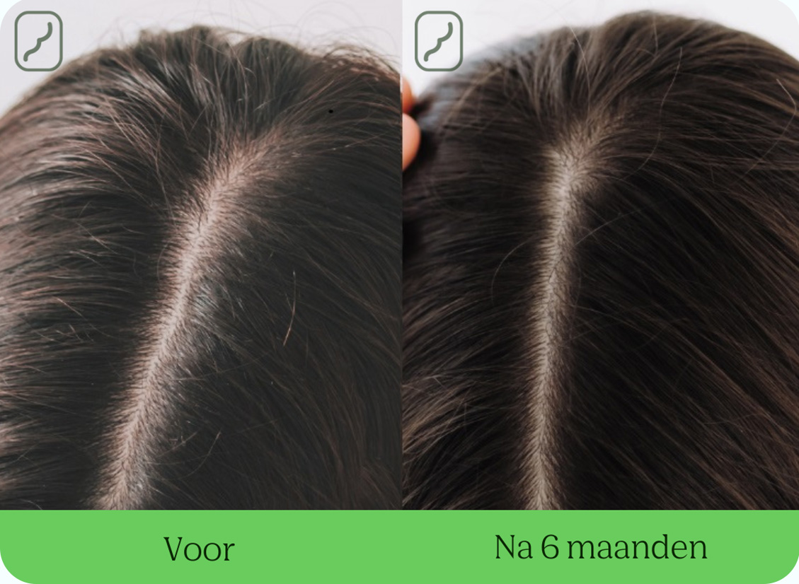 Peru Skim morfine ▷ Neofollics Anti-Grey Hair Tablets - Haargroeispecialist.nl
